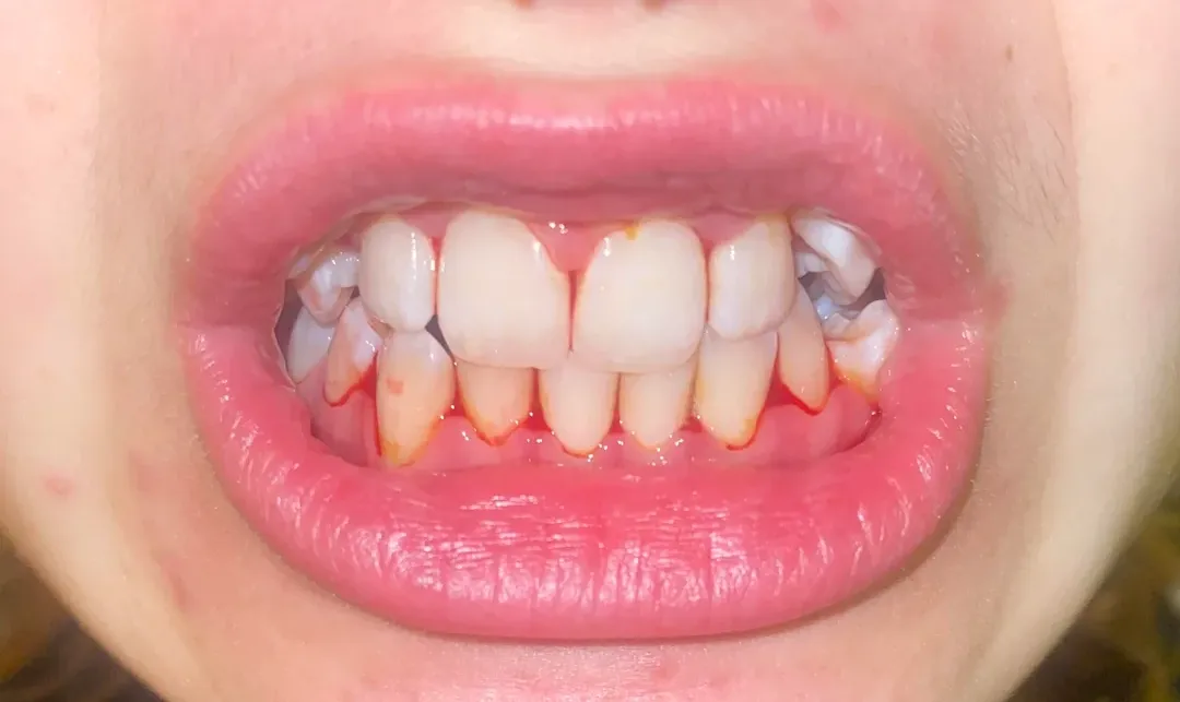 Bleeding gums close-up